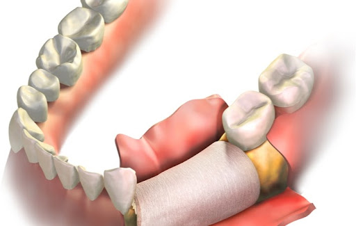 A 3D dental bone graft needed to help support a dental implant.