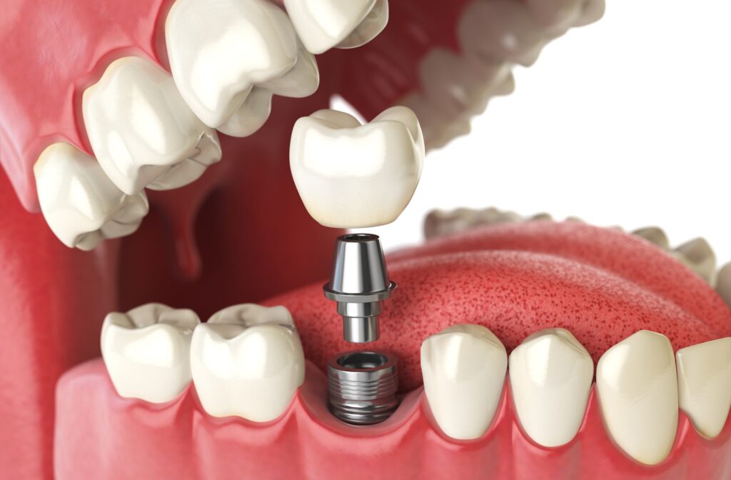 A 3D illustration of a dental implant placement