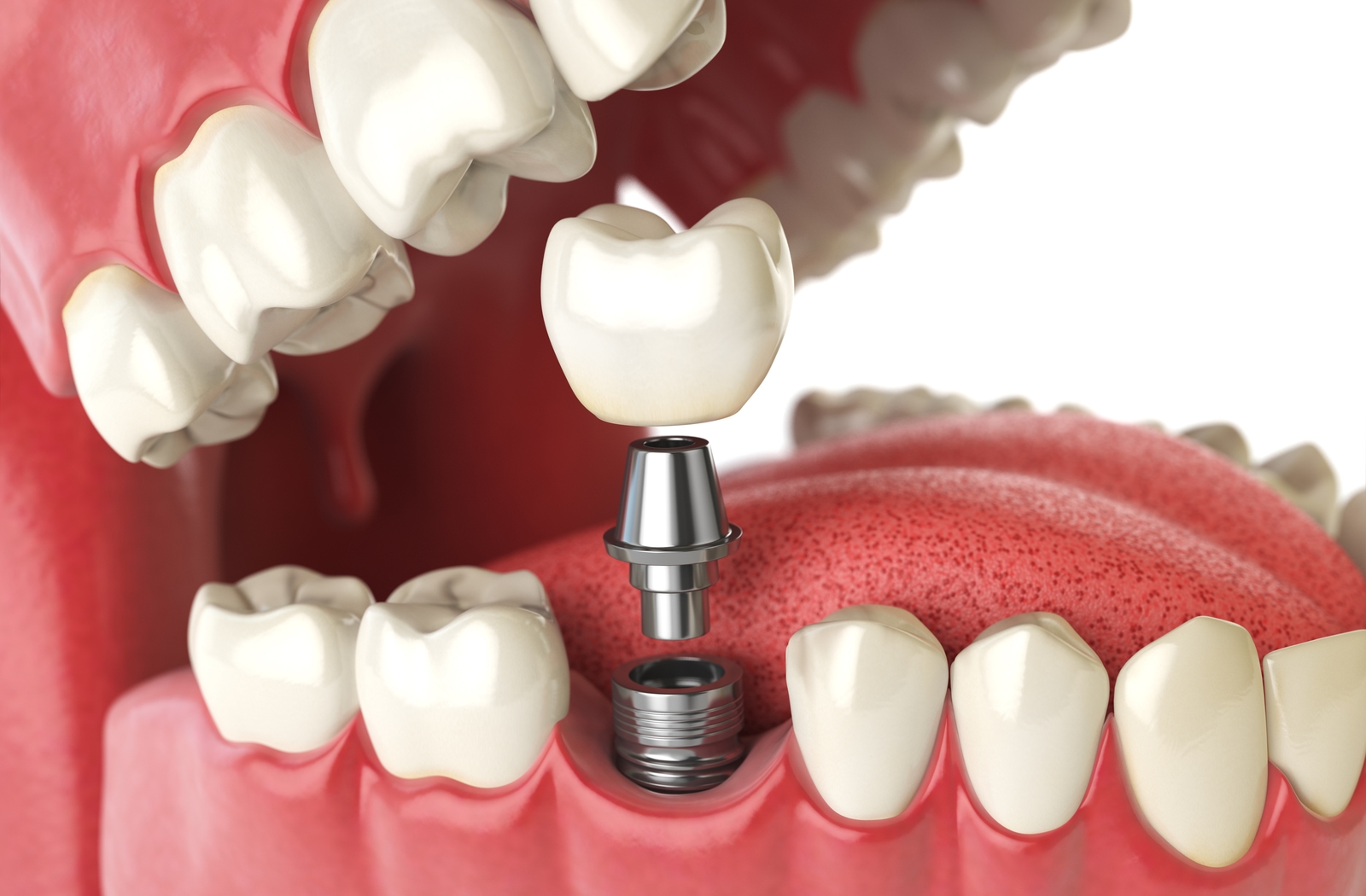 Can I Get a Dental Implant?｜Oakville｜Palermo Village Dental
