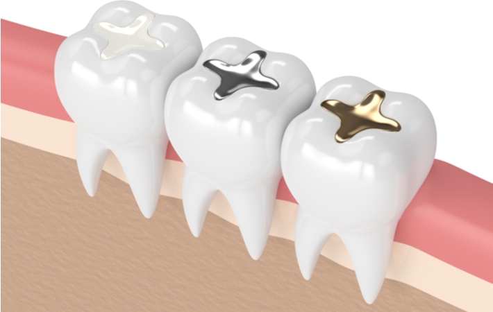 A 3D illustration of 3 teeth in a row, each with different types of dental fillings, including gold, amalgam and composite inlay