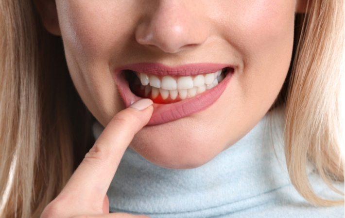 A woman using her finger to pull pack her lip to show her gum inflammation she is dealing with