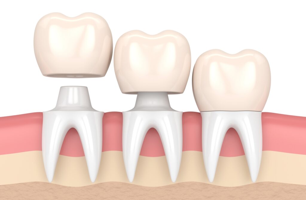 A 3d rendering of the placement of a dental crown separated into 3 stages