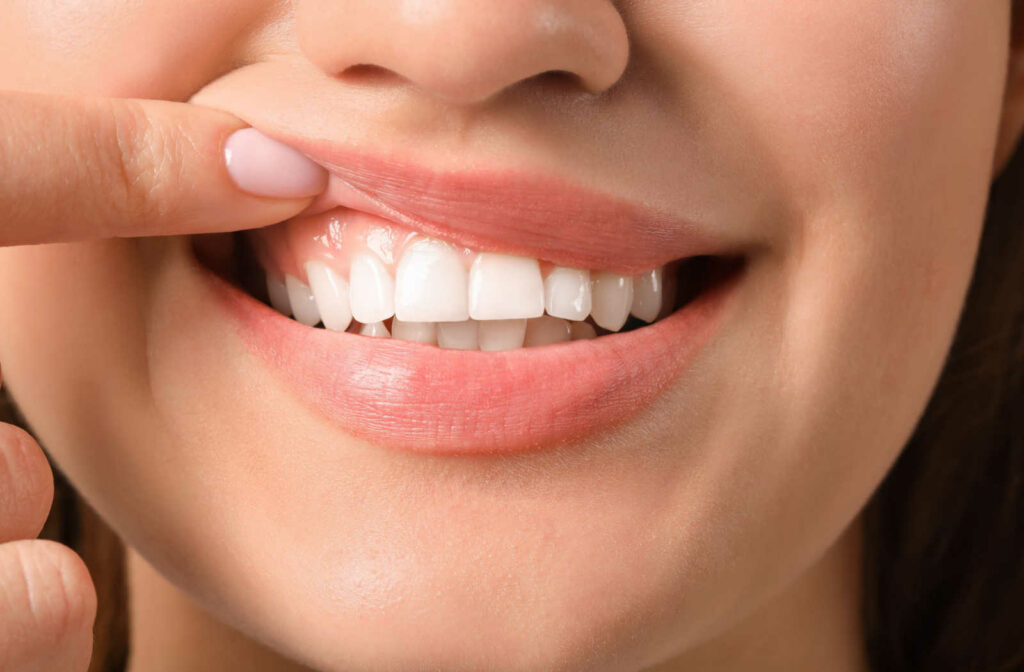 A close up of a smile with one finger pulling up the lip to show the gums and teeth