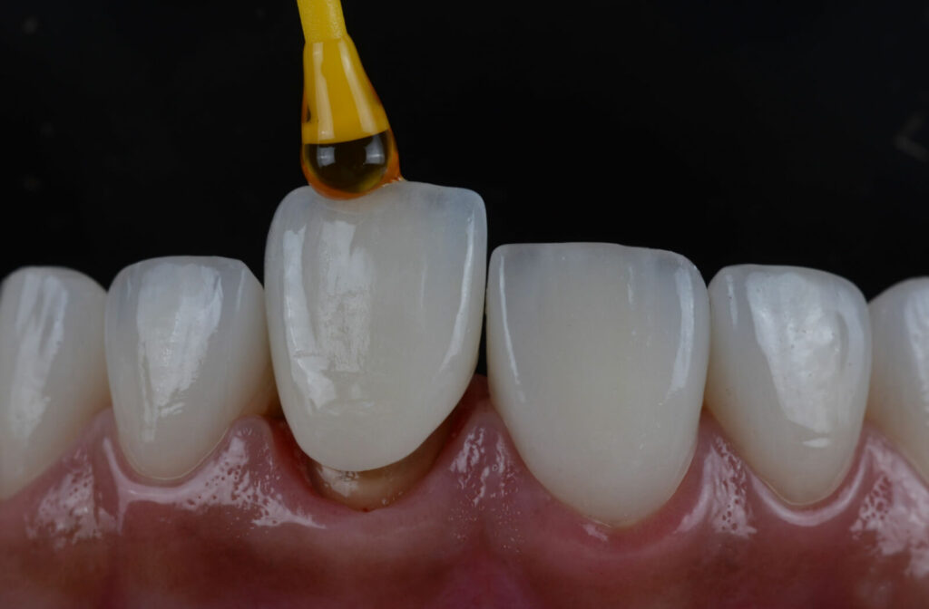 A close-up of a crown installation on a person's front teeth