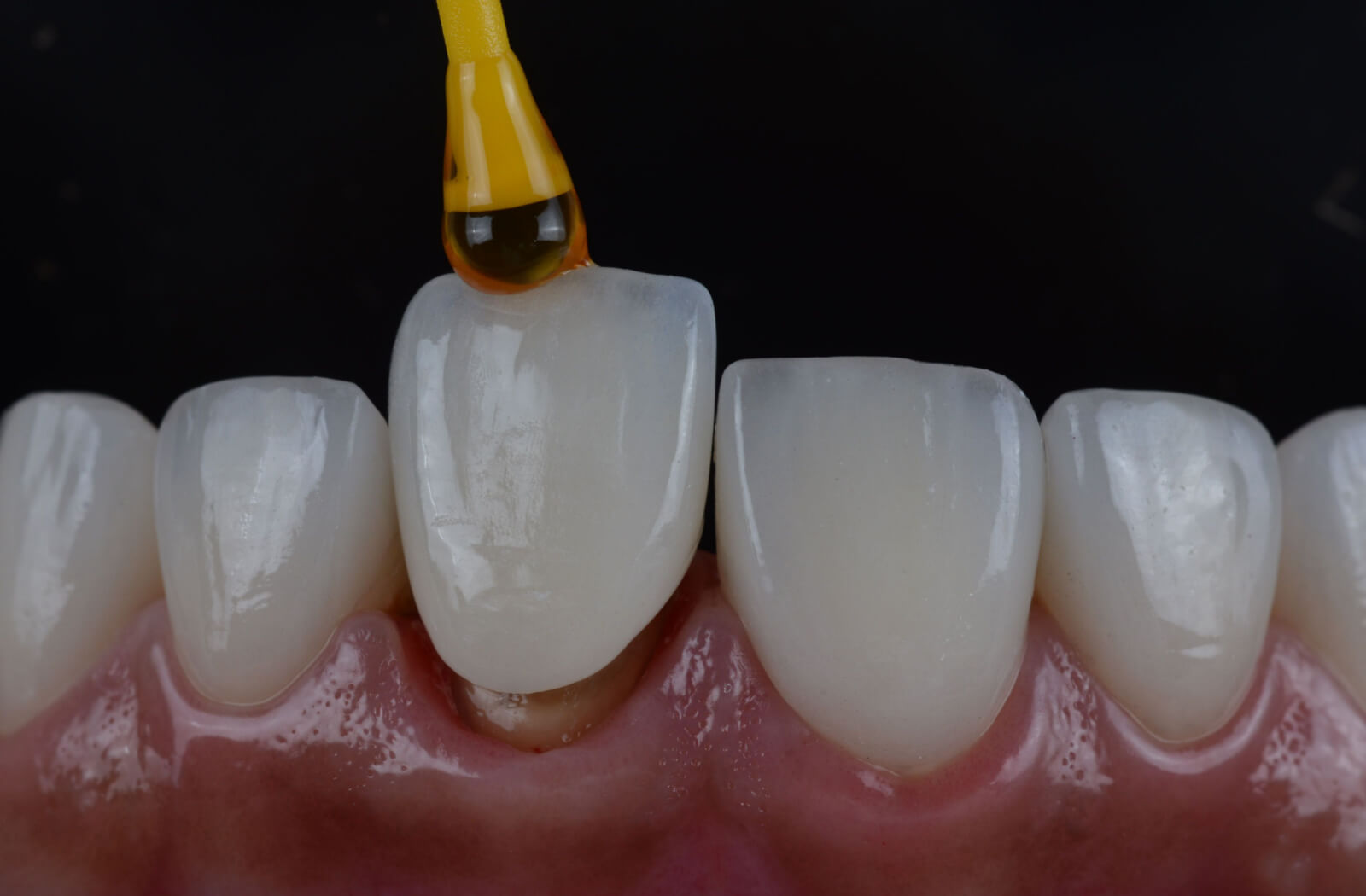 Front Tooth Zirconia Implants