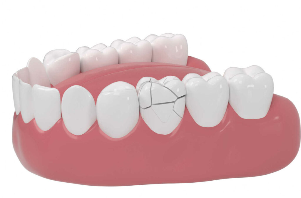A 3D image of a denture to show a cracked tooth.