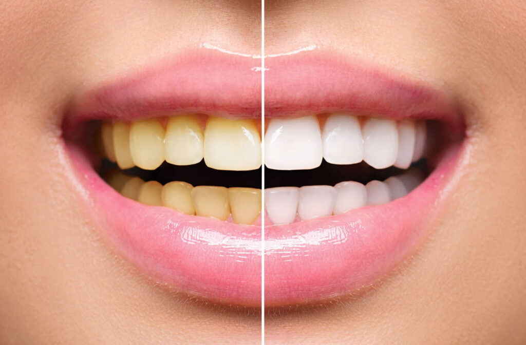 A woman's teeth showing before and after teeth whitening treatment at a dental clinic.