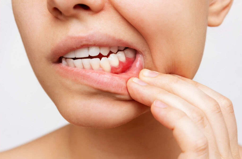 A close-up of a woman's teeth while she pulls her lower lip down to reveal bleeding in her gums.