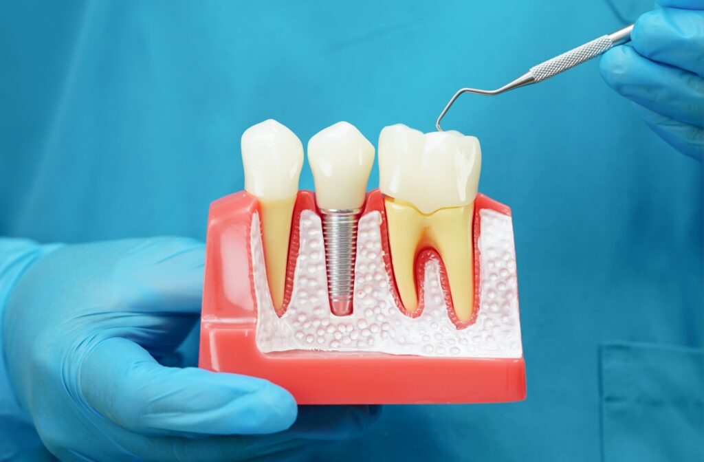 A dentist holds a model of dental implants that show how the implant goes into the bone, and also shows what a crown is and how it goes over the tooth seamlessly.