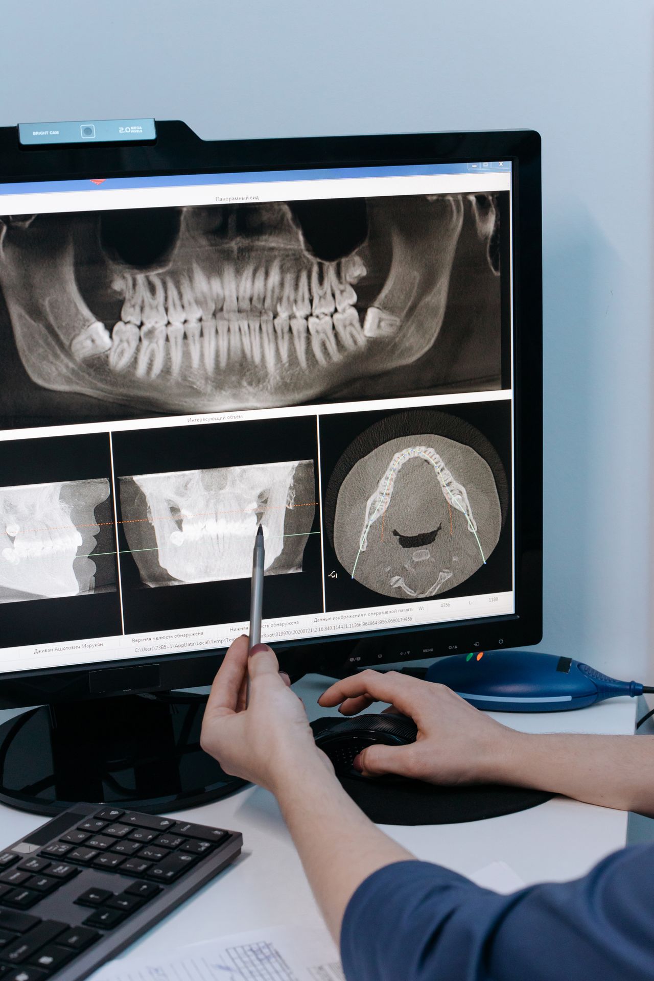 Dental professional analyzing wisdom teeth X-ray in Oakville