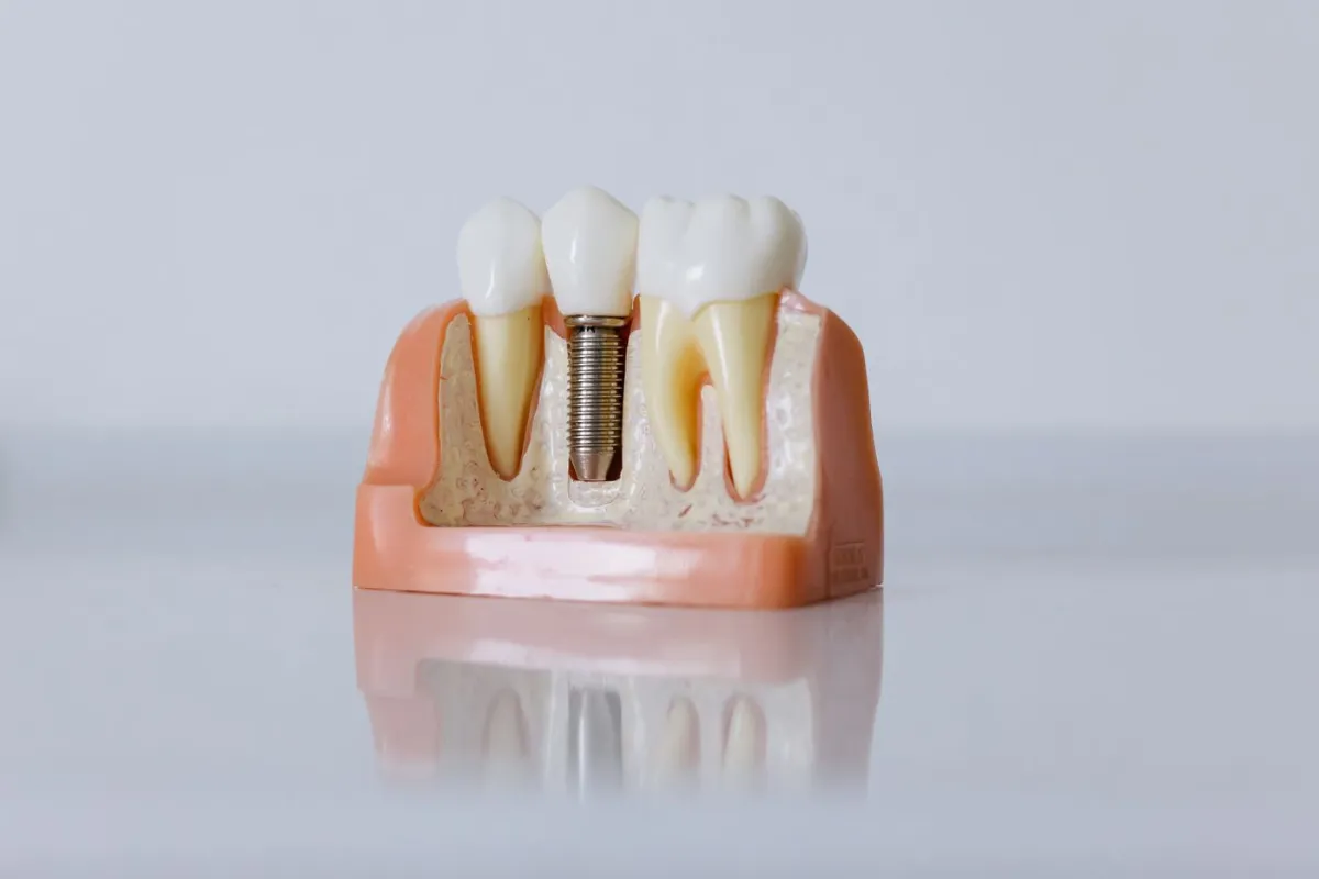 Dental implants in Oakville shown on a detailed implant model