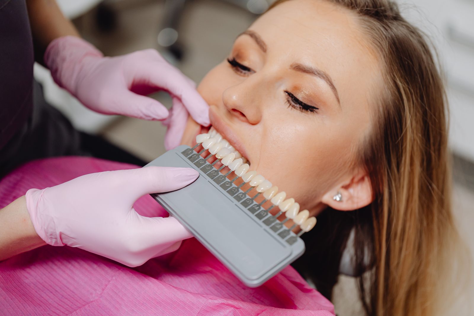 Does Teeth Whitening Work on Crowns and Veneers