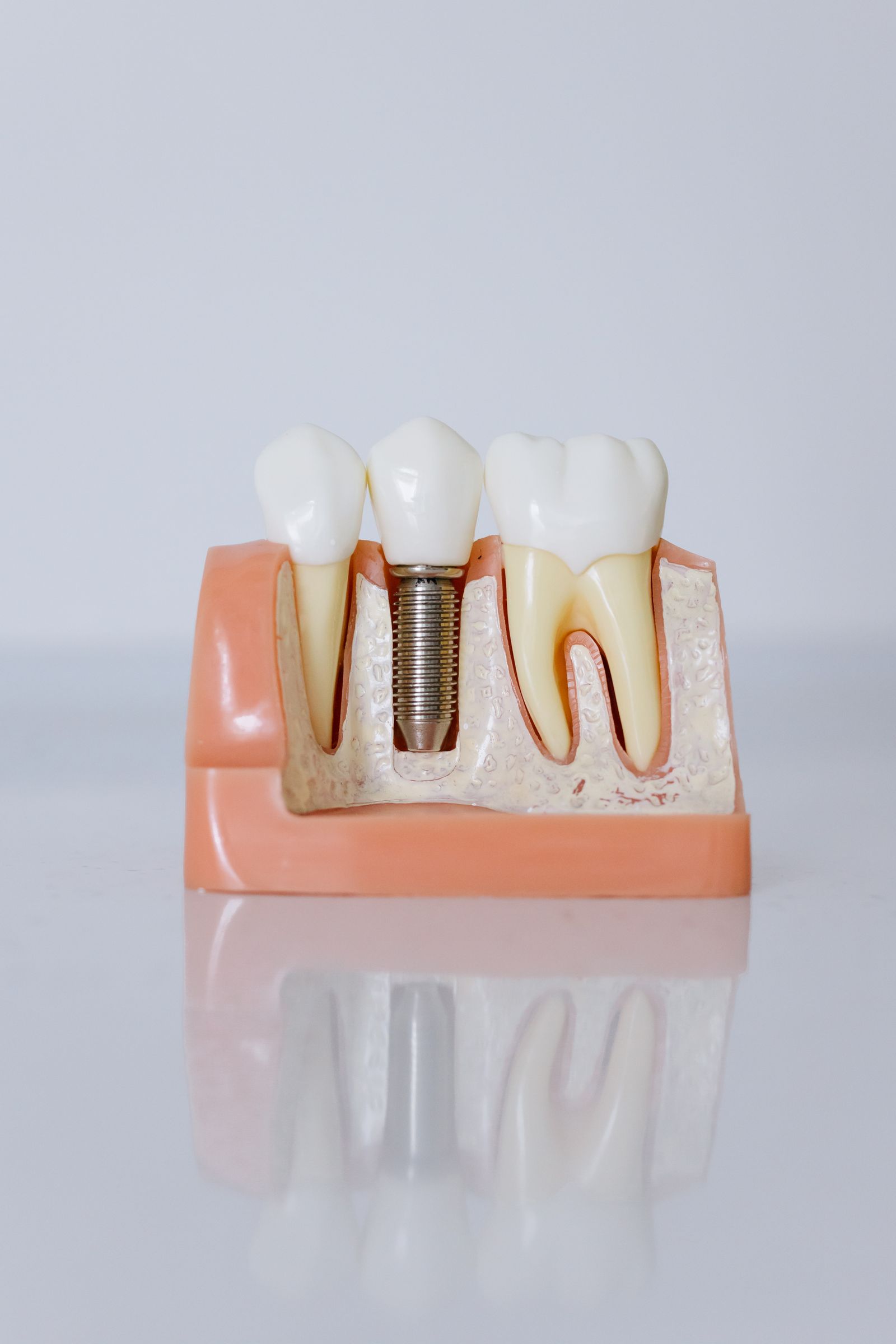 How Long Does the Dental Implant Process Take From Start to Finish