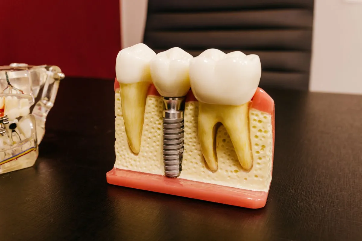 Dental implant post, abutment and crown components used for tooth replacement in Oakville